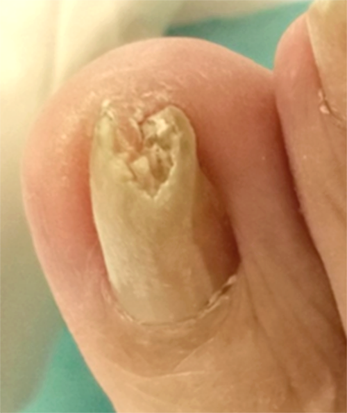 Nail3